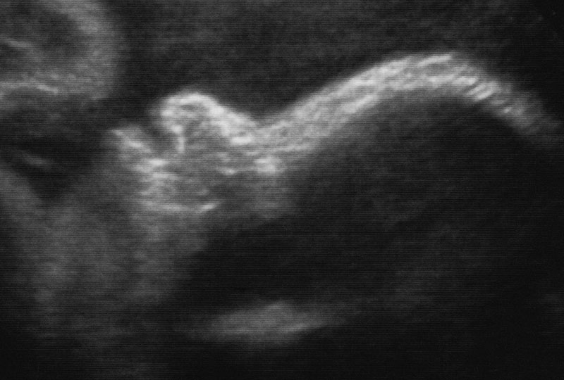 Max’s Profile at 33 Weeks & 2 Days